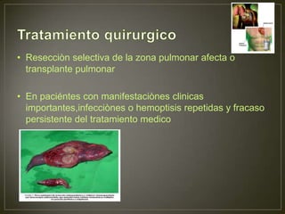 • Resecciòn selectiva de la zona pulmonar afecta o
  transplante pulmonar

• En paciéntes con manifestaciònes clinicas
  importantes,infecciònes o hemoptisis repetidas y fracaso
  persistente del tratamiento medico
 