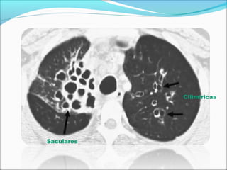 Saculares
Cilíndricas
 