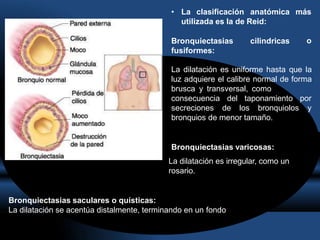 • La clasificación anatómica más
o
utilizada es la de Reid:
Bronquiectasias cilindricas
fusiformes:
La dilatación es uniforme hasta que la
luz adquiere el calibre normal de forma
brusca y transversal, como
consecuencia
secreciones
del taponamiento por
de los bronquiolos y
bronquios de menor tamaño.
Bronquiectasias varicosas:
La dilatación es irregular, como un
rosario.
Bronquiectasias saculares o quísticas:
La dilatación se acentúa distalmente, terminando en un fondo
 