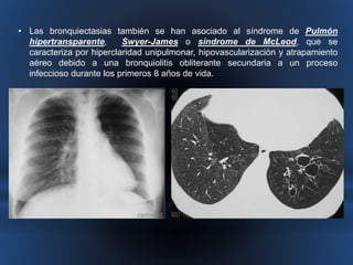 • Las bronquiectasias también se han asociado al síndrome de Pulmón 
hipertransparente, Swyer-James o síndrome de McLeod, que se 
caracteriza por hiperclaridad unipulmonar, hipovascularización y atrapamiento 
aéreo debido a una bronquiolitis obliterante secundaria a un proceso 
infeccioso durante los primeros 8 años de vida. 
 