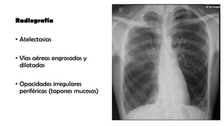 Radiografía
• Atelectasias
• Vías aéreas engrosadas y
dilatadas
• Opacidades irregulares
periféricas (tapones mucosos)
 