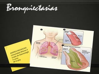 Bronquiectasias
 