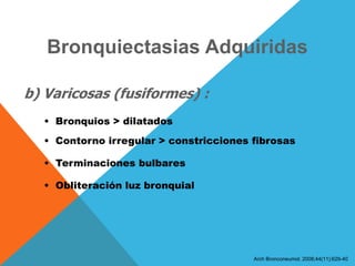 Bronquiectasias Adquiridas
b) Varicosas (fusiformes) :
• Bronquios > dilatados
• Contorno irregular > constricciones fibrosas
• Terminaciones bulbares
• Obliteración luz bronquial
Arch Bronconeumol. 2008;44(11):629-40
 