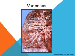 Varicosas
Arch Bronconeumol. 2008;44(11):629-40
 