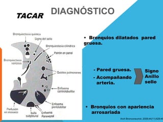 DIAGNÓSTICOTACAR
• Bronquios dilatados pared
gruesa.
- Pared gruesa.
- Acompañando
arteria.
Signo
Anillo
sello
• Bronquios con apariencia
arrosariada
Arch Bronconeumol. 2008;44(11):629-40
 