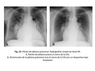 Fig. 13: Patrón de plétora pulmonar. Radiografías simple de tórax PA.
A. Patrón de plétora previo al cierre de la CIA.
B. Disminución de la plétora pulmonar tras el cierre de la CIA con un dispositivo tipo
Amplatzer

 