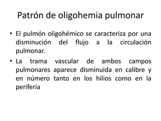 Patrón de oligohemia pulmonar
• El pulmón oligohémico se caracteriza por una
disminución del flujo a la circulación
pulmonar.
• La trama vascular de ambos campos
pulmonares aparece disminuida en calibre y
en número tanto en los hilios como en la
periferia

 