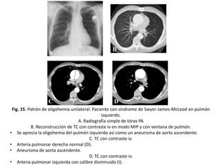 Fig. 15: Patrón de oligohemia unilateral. Paciente con síndrome de Swyer-James-McLeod en pulmón
izquierdo.
A. Radiografía simple de tórax PA
B. Reconstrucción de TC con contraste iv en modo MIP y con ventana de pulmón.
• Se aprecia la oligohemia del pulmón izquierdo así como un aneurisma de aorta ascendente.
C. TC con contraste iv.
• Arteria pulmonar derecha normal (D).
• Aneurisma de aorta ascendente.
D. TC con contraste iv.
• Arteria pulmonar izquierda con calibre disminuido (I).

 