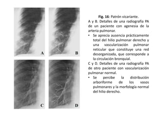 Fig. 16: Patrón vicariante.
A y B. Detalles de una radiografía PA
de un paciente con agenesia de la
arteria pulmonar.
• Se aprecia ausencia prácticamente
total del hilio pulmonar derecho y
una vascularización pulmonar
reticular que constituye una red
desorganizada, que corresponde a
la circulación bronquial.
C y D. Detalles de una radiografía PA
de otro paciente con vascularización
pulmonar normal.
• Se
percibe
la
distribución
arboriforme
de
los
vasos
pulmonares y la morfología normal
del hilio derecho.

 