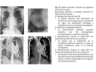 Fig. 17. Patrón vicariante. Paciente con agenesia
de la arteria y venas
pulmonares derechas y secuestro pulmonar en
lóbulo inferior derecho.
A. Radiografía simple de tórax PA.
• El pulmón derecho está disminuido de
volumen y en él se aprecia que su vasculatura
no sigue una distribución centrífuga y
arboriforme como en el pulmón contralateral.
B. Detalle de la radiografía anterior.
• La vascularización pulmonar izquierda
conforma
una
red
desorganizada,
correspondiente a circulación bronquial.
C. Reconstrucción coronal en modo MIP con
ventana de pulmón de TC con contraste iv.
• Se aprecia que la distribución de la
vasculatura pulmonar izquierda no sigue un
patrón arboriforme como en el pulmón
contralateral.
D. Reconstrucción coronal en modo MIP con
ventana de mediastino de TC con contraste iv.
• Se visualiza la arteria bronquial derecha y una
rama de la aorta toraco-abdominal (puntas de
flecha), la última responsable de la irrigación
del secuestro pulmonar.

 