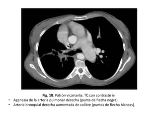 Fig. 18: Patrón vicariante. TC con contraste iv.
• Agenesia de la arteria pulmonar derecha (punta de flecha negra).
• Arteria bronquial derecha aumentada de calibre (puntas de flecha blancas).

 