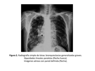 Figura 2. Radiografía simple de tórax: bronquiectasias generalizadas graves.
Opacidades lineales paralelas (flecha hueca).
Imágenes aéreas con pared definida (flecha).

 