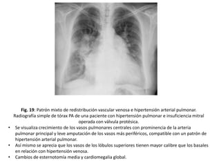 Fig. 19: Patrón mixto de redistribución vascular venosa e hipertensión arterial pulmonar.
Radiografía simple de tórax PA de una paciente con hipertensión pulmonar e insuficiencia mitral
operada con válvula protésica.
• Se visualiza crecimiento de los vasos pulmonares centrales con prominencia de la arteria
pulmonar principal y leve amputación de los vasos más periféricos, compatible con un patrón de
hipertensión arterial pulmonar.
• Así mismo se aprecia que los vasos de los lóbulos superiores tienen mayor calibre que los basales
en relación con hipertensión venosa.
• Cambios de esternotomía media y cardiomegalia global.

 