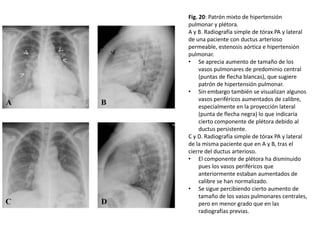 Fig. 20: Patrón mixto de hipertensión
pulmonar y plétora.
A y B. Radiografía simple de tórax PA y lateral
de una paciente con ductus arterioso
permeable, estenosis aórtica e hipertensión
pulmonar.
• Se aprecia aumento de tamaño de los
vasos pulmonares de predominio central
(puntas de flecha blancas), que sugiere
patrón de hipertensión pulmonar.
• Sin embargo también se visualizan algunos
vasos periféricos aumentados de calibre,
especialmente en la proyección lateral
(punta de flecha negra) lo que indicaría
cierto componente de plétora debido al
ductus persistente.
C y D. Radiografía simple de tórax PA y lateral
de la misma paciente que en A y B, tras el
cierre del ductus arterioso.
• El componente de plétora ha disminuido
pues los vasos periféricos que
anteriormente estaban aumentados de
calibre se han normalizado.
• Se sigue percibiendo cierto aumento de
tamaño de los vasos pulmonares centrales,
pero en menor grado que en las
radiografías previas.

 