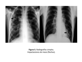 Figura 5. Radiografías simples.
Impactaciones de moco (flechas).

 