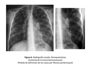 Figura 6. Radiografía simple. Bronquiectasias.
Aumento de la trama broncovascular.
Pérdida de definición de los vasos por fibrosis peribronquial.

 