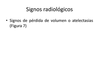 Signos radiológicos
• Signos de pérdida de volumen o atelectasias
(Figura 7)

 
