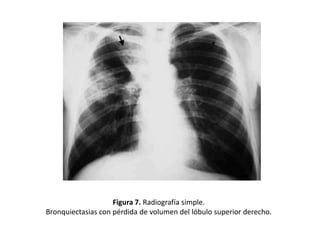 Figura 7. Radiografía simple.
Bronquiectasias con pérdida de volumen del lóbulo superior derecho.

 