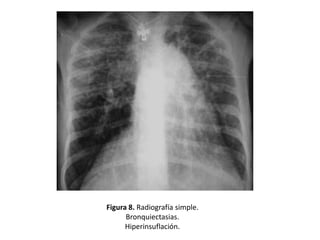 Figura 8. Radiografía simple.
Bronquiectasias.
Hiperinsuflación.

 