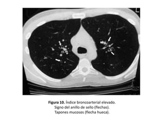 Figura 10. Índice broncoarterial elevado.
Signo del anillo de sello (flechas).
Tapones mucosos (flecha hueca).

 