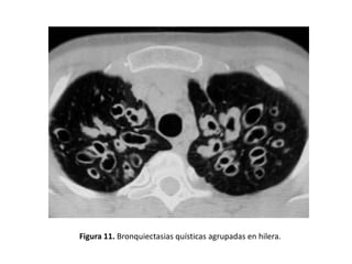 Figura 11. Bronquiectasias quísticas agrupadas en hilera.

 