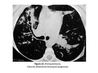 Figura 12. Bronquiectasias.
Falta de afilamiento bronquial progresivo.

 