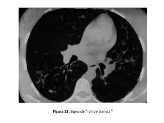 Figura 13. Signo de “raíl de tranvía ”

 