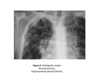 Figura 9. Radiografía simple.
Bronquiectasias.
Engrosamiento pleural (flecha).

 