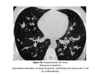 Figura 16. Impactaciones de moco.
Bronquio en positivo.
Opacidades lobuladas, en dedo de guante, ramificadas (en foprma de Y o de
V) y redondeadas.

 