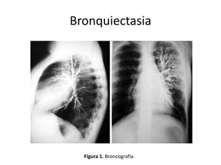 Bronquiectasia

Figura 1. Broncografía

 