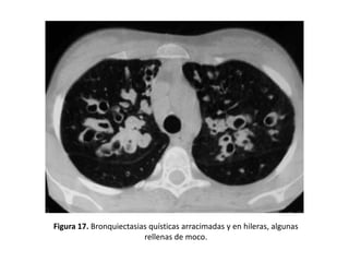 Figura 17. Bronquiectasias quísticas arracimadas y en hileras, algunas
rellenas de moco.

 