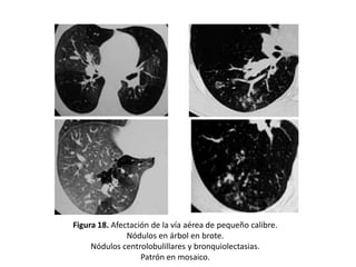 Figura 18. Afectación de la vía aérea de pequeño calibre.
Nódulos en árbol en brote.
Nódulos centrolobulillares y bronquiolectasias.
Patrón en mosaico.

 