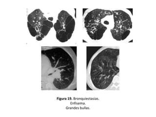 Figura 19. Bronquiectasias.
Enfisema.
Grandes bullas.

 