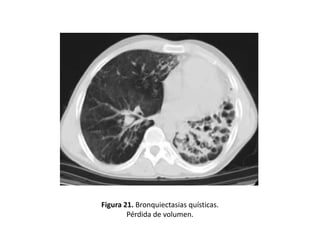 Figura 21. Bronquiectasias quísticas.
Pérdida de volumen.

 