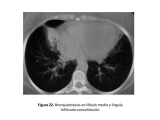 Figura 22. Bronquiectasias en lóbulo medio y língula.
Infiltrado-consolidación.

 