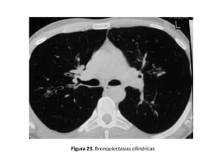 Figura 23. Bronquiectasias cilíndricas

 