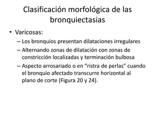 Clasificación morfológica de las
bronquiectasias
• Varicosas:
– Los bronquios presentan dilataciones irregulares
– Alternando zonas de dilatación con zonas de
constricción localizadas y terminación bulbosa
– Aspecto arrosariado o en “ristra de perlas” cuando
el bronquio afectado transcurre horizontal al
plano de corte (Figura 20 y 24).

 
