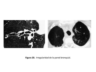 Figura 20. Irregularidad de la pared bronquial.

 