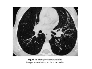 Figura 24. Bronquiectasias varicosas.
Imagen arrosariada o en ristra de perlas.

 
