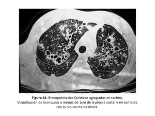 Figura 14. Bronquiectasias Quísticas agrupadas en racimo.
Visualización de bronquios a menos de 1cm de la pleura costal y en contacto
con la pleura mediastínica.

 