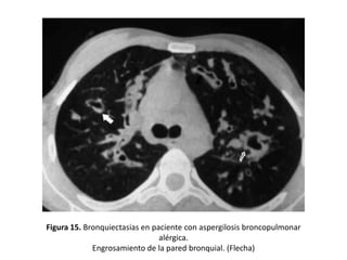 Figura 15. Bronquiectasias en paciente con aspergilosis broncopulmonar
alérgica.
Engrosamiento de la pared bronquial. (Flecha)

 