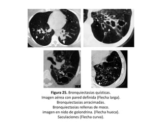 Figura 25. Bronquiectasias quísticas.
Imagen aérea con pared definida (Flecha larga).
Bronquiectasias arracimadas.
Bronquiectasias rellenas de moco.
imagen en nido de golondrina. (Flecha hueca).
Saculaciones (Flecha curva).

 