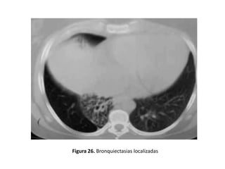 Figura 26. Bronquiectasias localizadas

 
