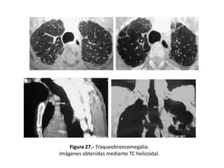 Figura 27.- Traqueobroncomegalia.
Imágenes obtenidas mediante TC helicoidal.

 