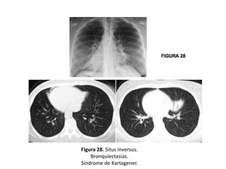 Figura 28. Situs inversus.
Bronquiectasias.
Síndrome de Kartagener.

 
