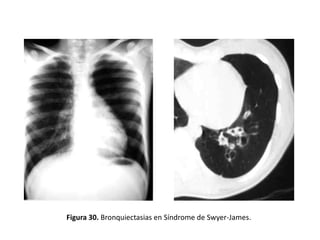 Figura 30. Bronquiectasias en Síndrome de Swyer-James.

 
