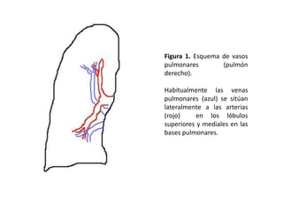 Figura 1. Esquema de vasos
pulmonares
(pulmón
derecho).
Habitualmente las venas
pulmonares (azul) se sitúan
lateralmente a las arterias
(rojo)
en los lóbulos
superiores y mediales en las
bases pulmonares.

 