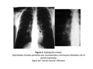 Figura 3. Radiografía simple.
Opacidades lineales paralelas que corresponden a bronquios dilatados con la
pared engrosada.
Signo del “raíl de tranvía” (flechas).

 