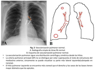 •
•
•

Fig. 2: Vascularización pulmonar normal.
A. Radiografía simple de tórax PA normal.
B. Esquema de vascularización pulmonar normal.
La vascularización pulmonar sigue una distribución centrífuga y simétrica desde los hilios.
La arteria pulmonar principal (AP) no se distingue por estar superpuesta al resto de estructuras del
mediastino anterior, únicamente se puede visualizar su parte más lateral izquierda(subrayado en
naranja).
El hilio pulmonar izquierdo se encuentra más craneal que el derecho y los vasos de las bases tienen
mayor diámetro que los apicales.

 