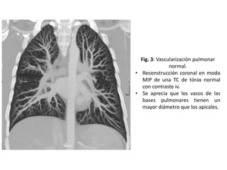 Fig. 3: Vascularización pulmonar
normal.
• Reconstrucción coronal en modo
MIP de una TC de tórax normal
con contraste iv.
• Se aprecia que los vasos de las
bases pulmonares tienen un
mayor diámetro que los apicales.

 
